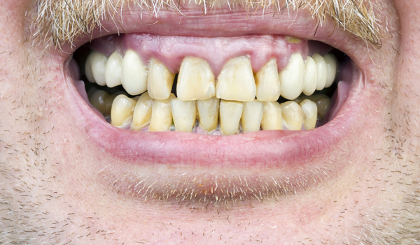 photo of periodontal disease