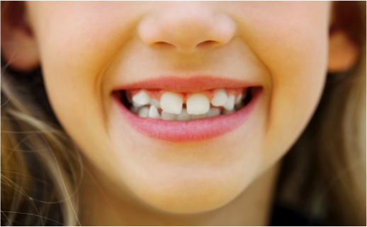child with crooked teeth