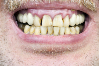 photo of periodontal disease