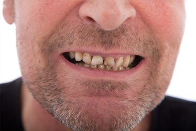 man with bad gum needs diagnosing gum disease