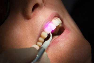woman getting laser dentistry treatment
