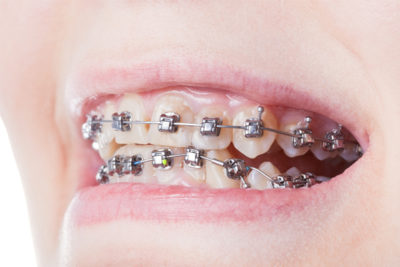 girl with braces after visiting Orthodontist 